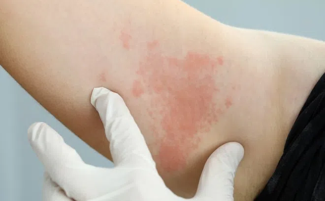 Biểu hiện tưởng bình thường nhưng có thể là dấu hiệu sớm của HIV