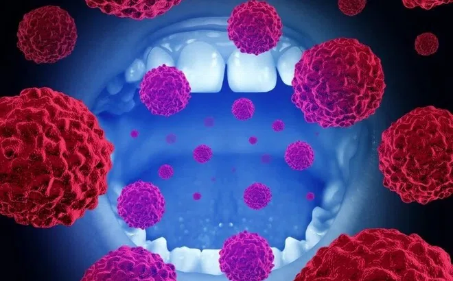 Triệu chứng âm thầm cảnh báo ung thư miệng