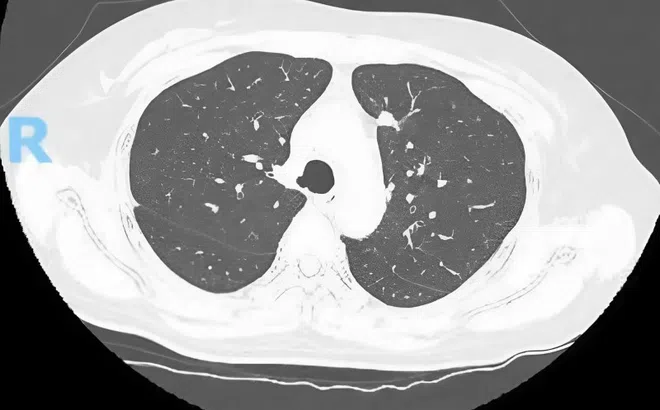 Bất ngờ phát hiện mắc ung thư từ nốt mờ nhỏ ở phổi