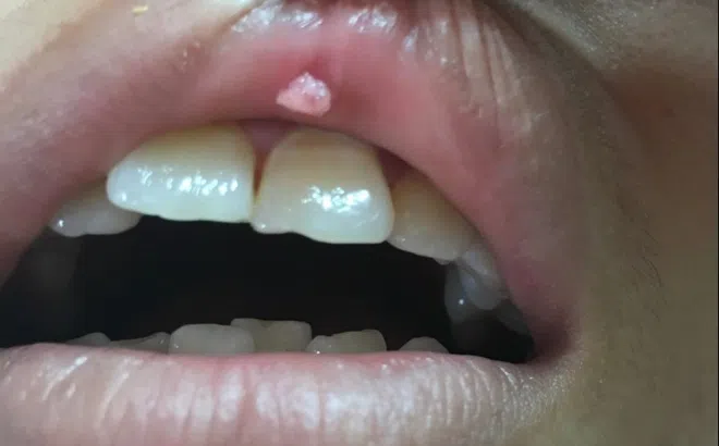 Dấu hiệu của sùi mào gà giai đoạn đầu