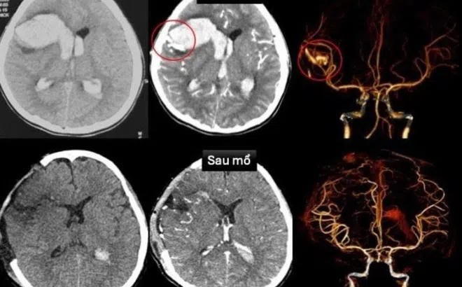 Bé gái TP.HCM vỡ mạch máu não, sốc tim nguy kịch khi đang ngủ