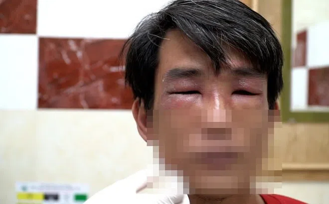 Kiến ba khoang tấn công người ở TP.HCM