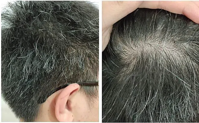 Có phải ‘tóc bạc nhiều là dấu hiệu của ung thư’?