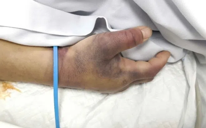 Người đàn ông nguy kịch vì căn bệnh ai cũng chủ quan