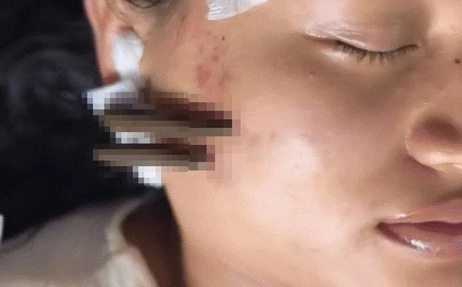 Clip đỉa 'hút độc' gây kinh hãi MXH: Bác sĩ lên tiếng