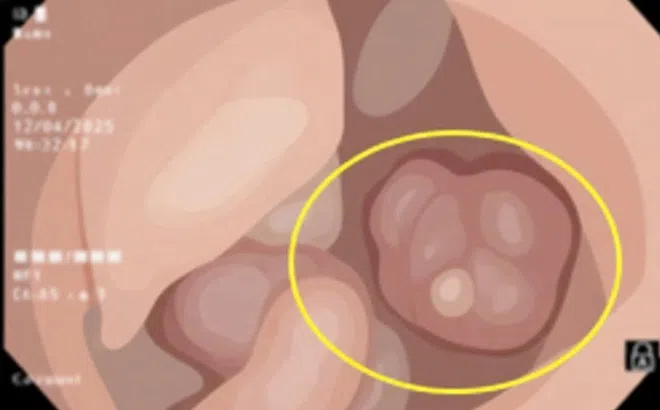 Người đàn ông có 3 dấu hiệu của bệnh ung thư nhưng không biết